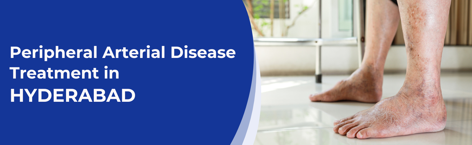 Peripheral Arterial Disease Treatment in Hyderabad